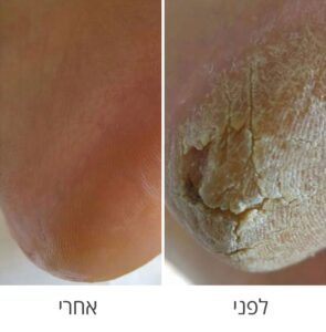 לפני ואחרי טיפול בכף רגל יבשה וסדוקה, צילום נירהה סלנט